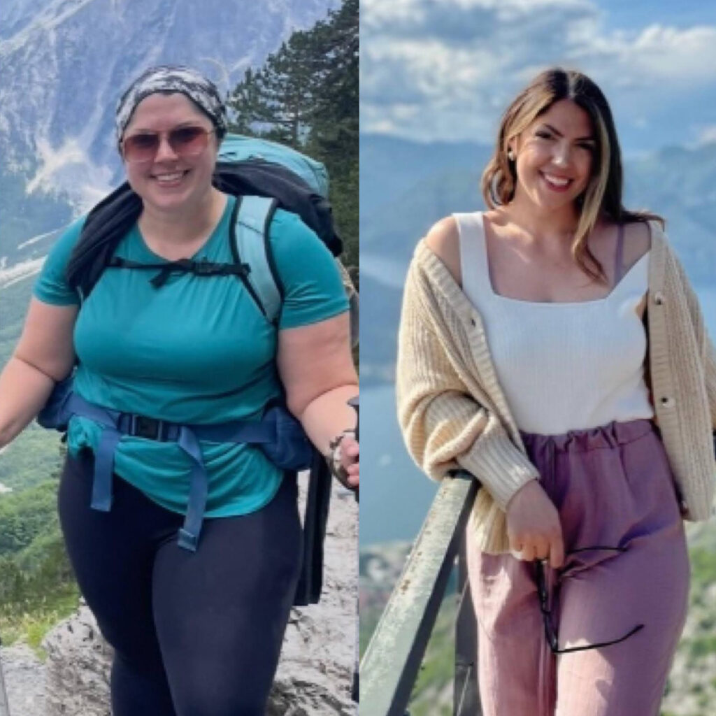 Before and after patient who has undergone medical weight loss